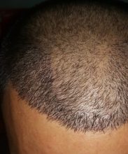 dr-kul-hair-transplant-results (16)