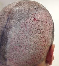 dr-kul-hair-transplant-results (17)