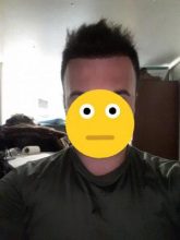 dr-kul-hair-transplant-results (18)