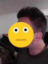 dr-kul-hair-transplant-results (3)