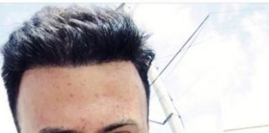 dr-kul-hair-transplant-results (8)