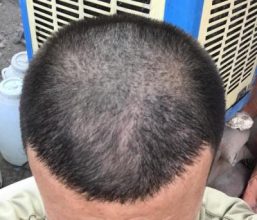 dr-kul-hair-transplant-results (9)