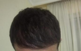 hair-restoration (22)