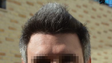 hair-transplant-in-turkey-cost (10)