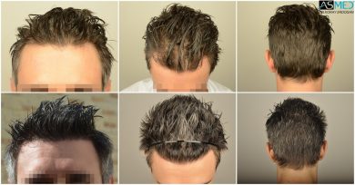 hair-transplant-in-turkey-cost (11)