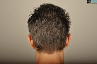 hair-transplant-in-turkey-cost (8)