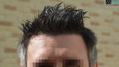 hair-transplant-in-turkey-cost (9)