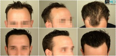 hair transplant in turkey review (1)