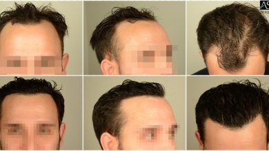 hair transplant in turkey review (1)