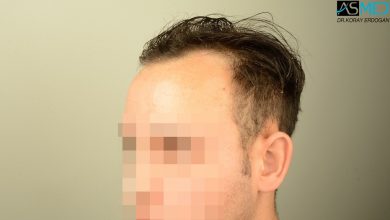 hair-transplant-in-turkey-review (1)