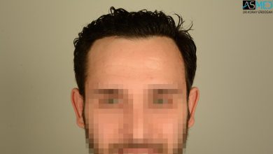 hair-transplant-in-turkey-review (10)