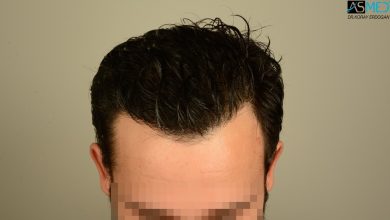 hair-transplant-in-turkey-review (11)