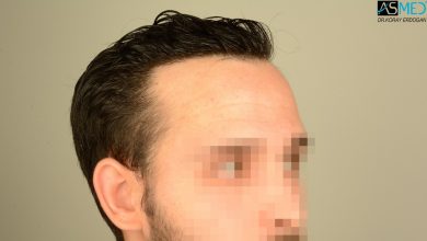 hair-transplant-in-turkey-review (12)