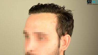 hair-transplant-in-turkey-review (13)