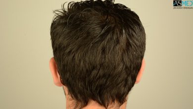 hair-transplant-in-turkey-review (14)