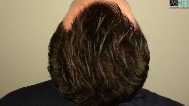 hair-transplant-in-turkey-review (15)