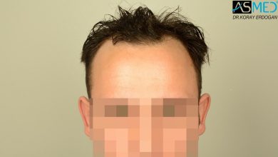 hair-transplant-in-turkey-review (16)