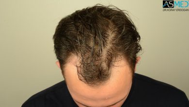 hair-transplant-in-turkey-review (17)