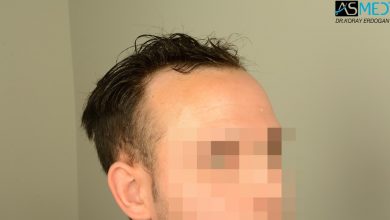 hair-transplant-in-turkey-review (18)