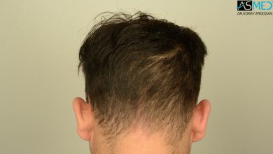 hair-transplant-in-turkey-review (2)