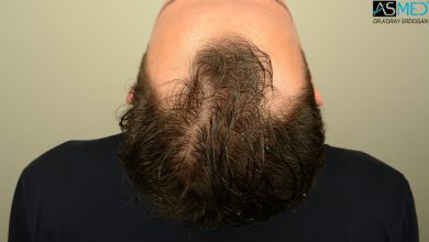 hair-transplant-in-turkey-review (3)