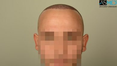 hair-transplant-in-turkey-review (4)