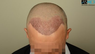 hair-transplant-in-turkey-review (5)