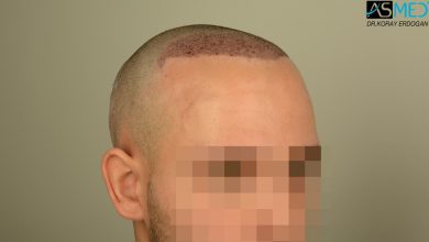 hair-transplant-in-turkey-review (6)