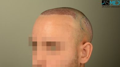 hair-transplant-in-turkey-review (7)