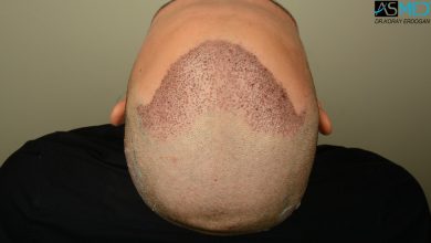 hair-transplant-in-turkey-review (9)