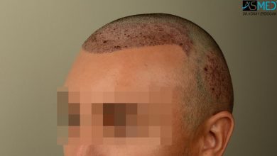 hair-transplant-near-me (10)