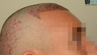 hair-transplant-near-me (13)