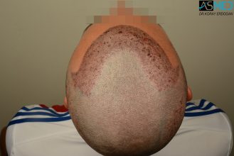 hair-transplant-near-me (14)