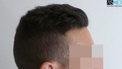 hair-transplant-near-me (15)