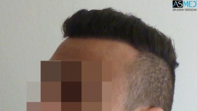 hair-transplant-near-me (16)
