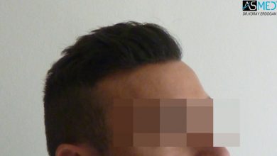 hair-transplant-near-me (17)