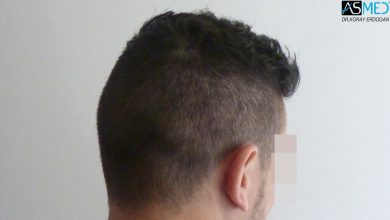 hair-transplant-near-me (19)