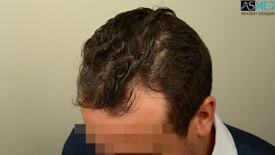 hair-transplant-near-me (2)