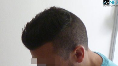 hair-transplant-near-me (21)