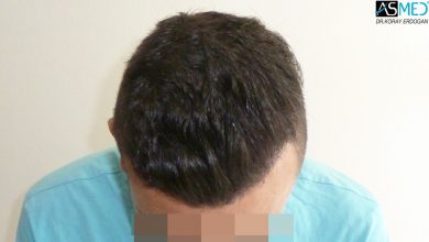 hair-transplant-near-me (22)