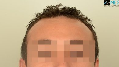 hair-transplant-near-me (25)