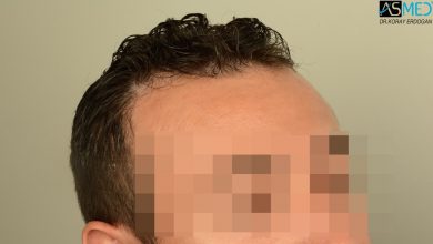 hair-transplant-near-me (27)