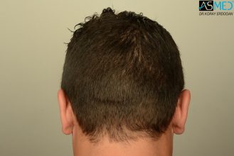 hair-transplant-near-me (3)