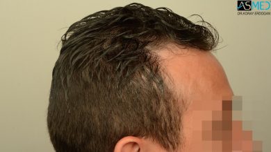 hair-transplant-near-me (4)
