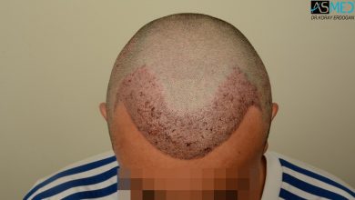 hair-transplant-near-me (7)