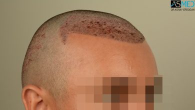 hair-transplant-near-me (8)