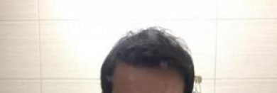 hair-transplant-review-istanbul (1)