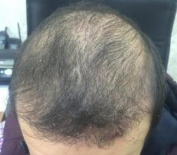 hair-transplant-review-istanbul (10)