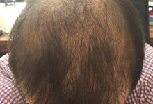 hair-transplant-review-istanbul (11)