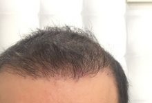 hair-transplant-review-istanbul (12)